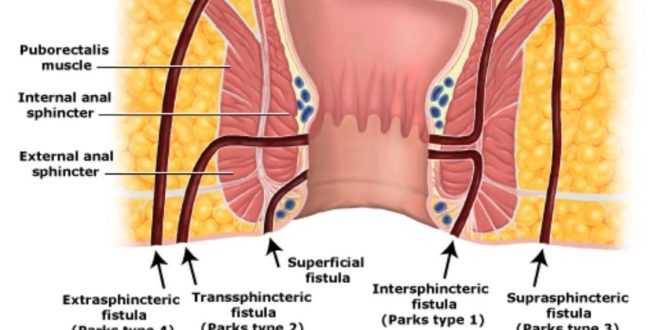 ফিস্টুলা রোগের কারণ, প্রতিকার ও চিকিৎসা